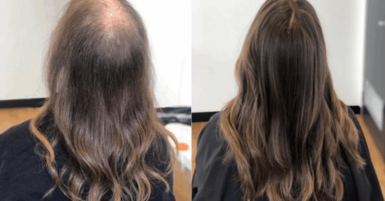 Best Hair Loss Treatment for Women: Complete Guide to Causes, Solutions & Long-Term Care